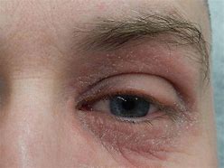 Image result for Eczema On Eyelids Treatment