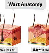 Image result for warts remove surgical