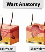 Image result for Wart On Thigh Removal
