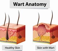 Image result for Surgical Wart Removal