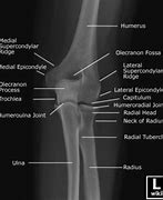 Image result for X-ray of Elbow Joint