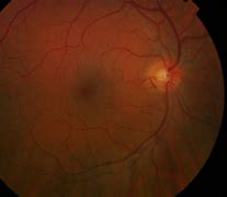 Image result for Retina Photopsias