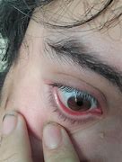 Image result for Messed Up Eyes