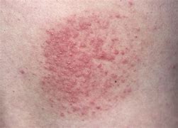 Image result for The Scariest Skin Eruptions