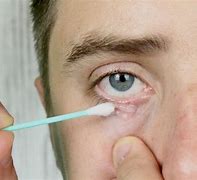 Image result for Folliculitis Eye