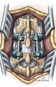 Image result for Spinal Fusion Procedure