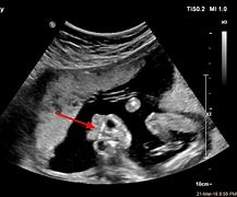 Image result for Severe Anencephaly Ultrasound