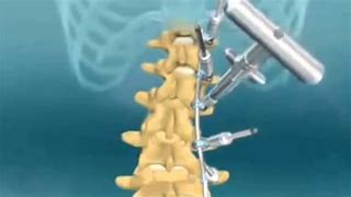 Image result for Spinal Fusion Procedure