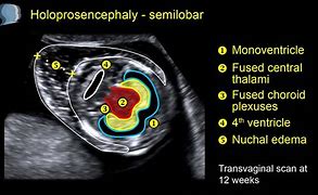 Image result for Lobar Holoprosencephaly Ultrasound