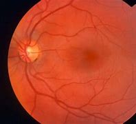 Image result for Normal Fundus Photography