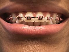 Image result for Braces with Pink Bands