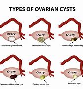 Image result for How Big Is 5 Cm Cyst
