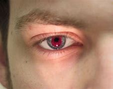 Image result for acromatopsia