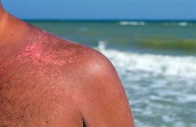 Image result for SunBurn Pics