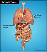 Image result for Carcinoid Tumor