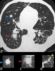 Image result for What Is a Lung Nodule