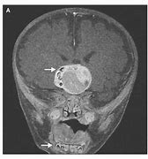 Image result for Brain Tumor with Teeth