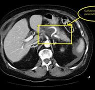 Image result for Pancreatitis CT Findings