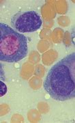 Image result for Small Cell Carcinoma Cytology