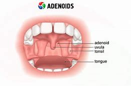 Image result for adenodo