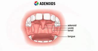 Image result for adenoidez