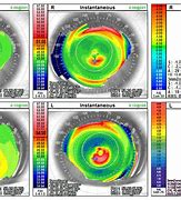 Image result for Eye Topography Before and After Lasik