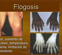 Image result for flogosis