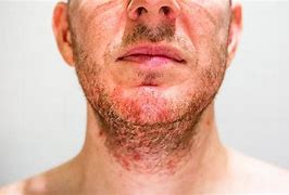 Image result for Dermatitis Rash On Face