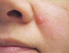 Image result for Basal Cell Carcinoma On Forehead