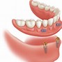 Image result for Locator Full Denture