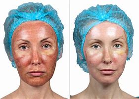 Image result for Chemical Peel During