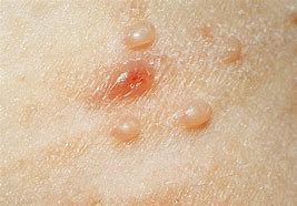 Image result for Molluscum Contagiosum Thoracica Photo