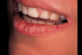 Image result for Ringworm around Mouth