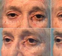 Image result for Basal Cell Carcinoma On Lower Eyelid