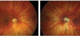 Image result for Moderate Myopia