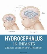 Image result for Hydrocephalus Baby Development