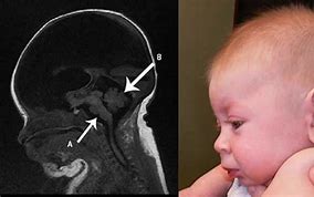 Image result for Hidrancephaly