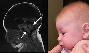 Image result for Hydrancephaly MRI