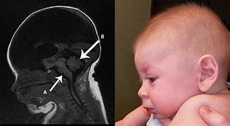 Image result for Moon Phases Hydranencephaly