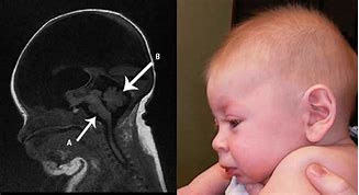 Image result for Hydranencephaly