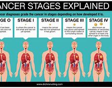 Image result for Head Cancer Symptoms