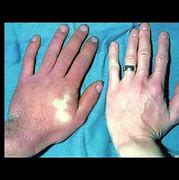 Image result for acicosis