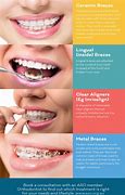 Image result for Straighten Teeth without Braces