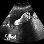 Image result for 9 Week Pregnancy Ultrasound