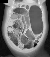 Image result for Distended Small Bowel