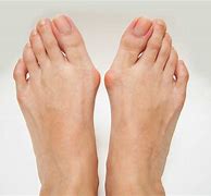 Image result for Bunions in Kids