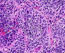 Image result for Carcinoid Lesion