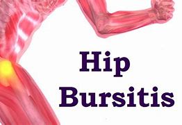 Image result for Hip Bursitis Physical Therapy