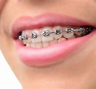 Image result for Brackets Teeth Braces