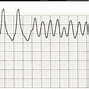 Image result for asystole